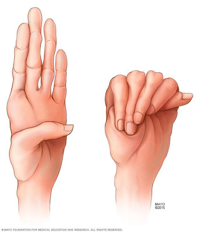 Marfan syndrome