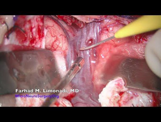 Brain Aneurysm Surgery: Surgical clipping of an MCA aneurysm which could not be coiled.