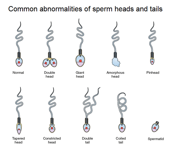 and birth defects Misshapen sperm