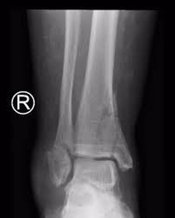 Pilon fracture