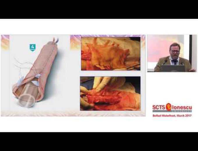 Recent Advances in Tracheal Surgery
