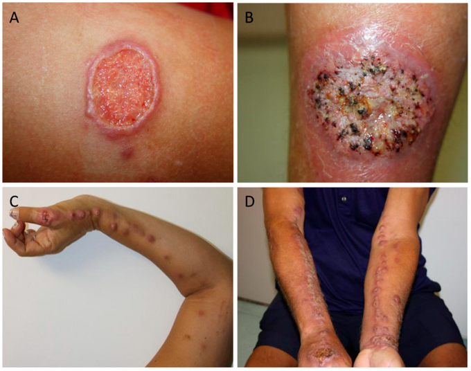 Cutaneous Manifestations of Sporotrichosis