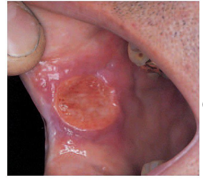 Aphthous stomatitis, major type.