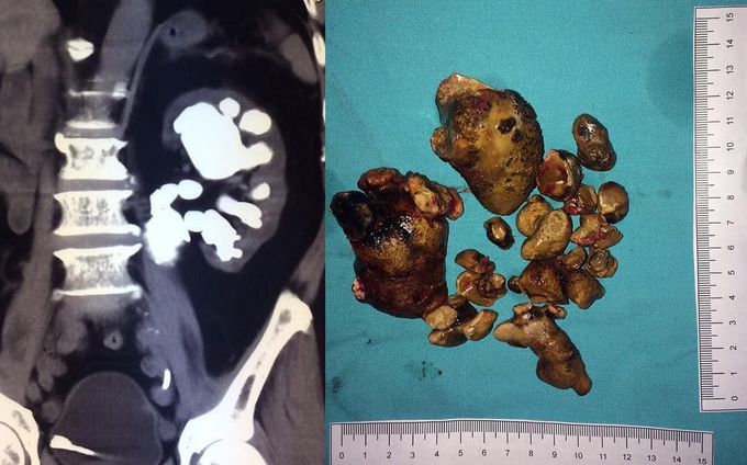 Multiple kidney's stone