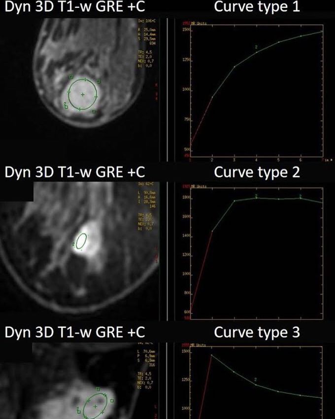 Three possible enhancement kinetic curves in breast MR Imaging
