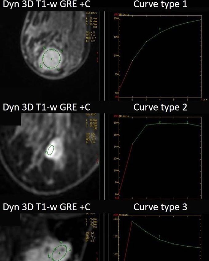 Three possible enhancement kinetic curves in breast MR - MEDizzy