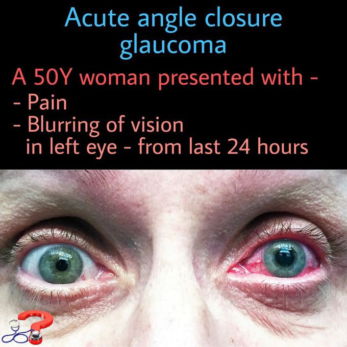 acute angle closure glaucoma