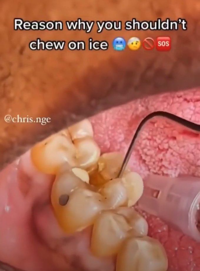 Tooth fracture- Chewing on Ice