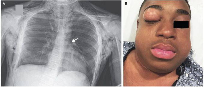 Diffuse Subcutaneous Emphysema