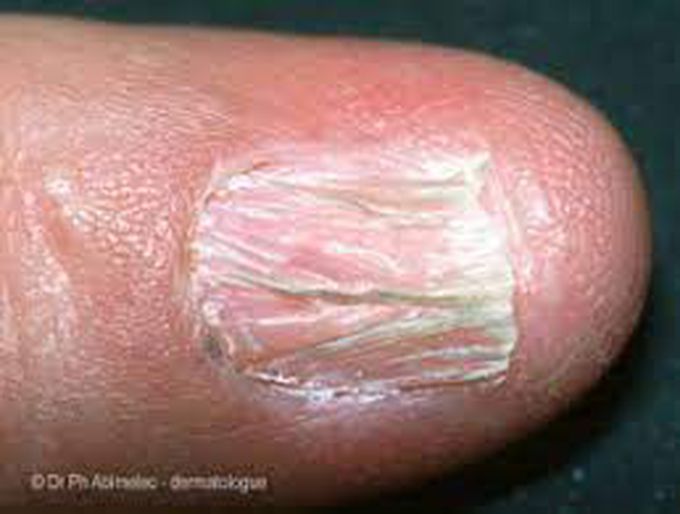 Nail Changes in Lichen Planus