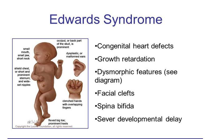 Edward syndrome