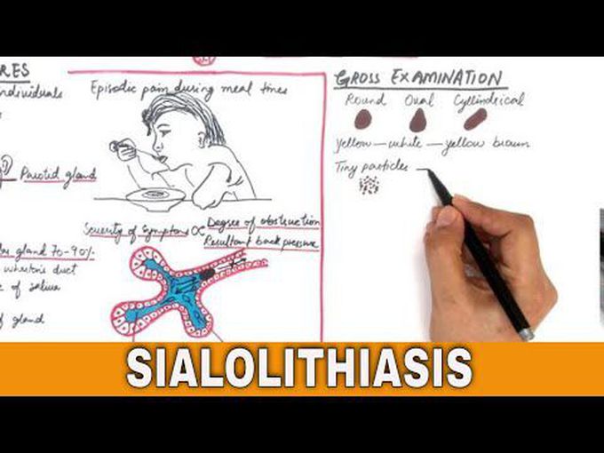 Sialolithiasis: Overview