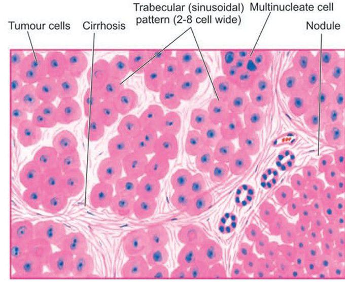 Hepatocellular carcinoma, typical microscopic pattern.