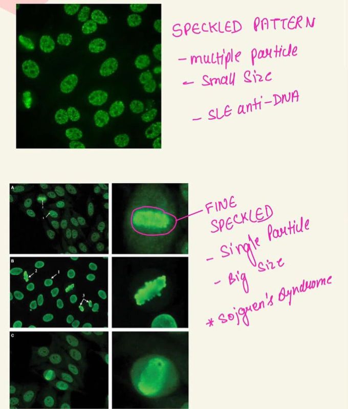 SLE- Immunofluorescence