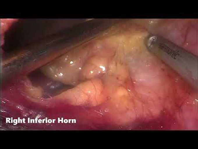 Non-Intubated Subxiphoid Multiport VATS Thymectomy