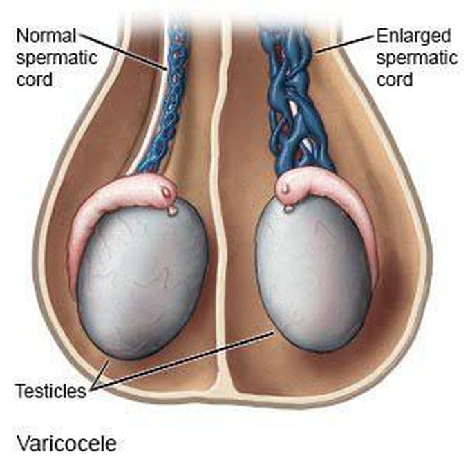 Varicocele MEDizzy