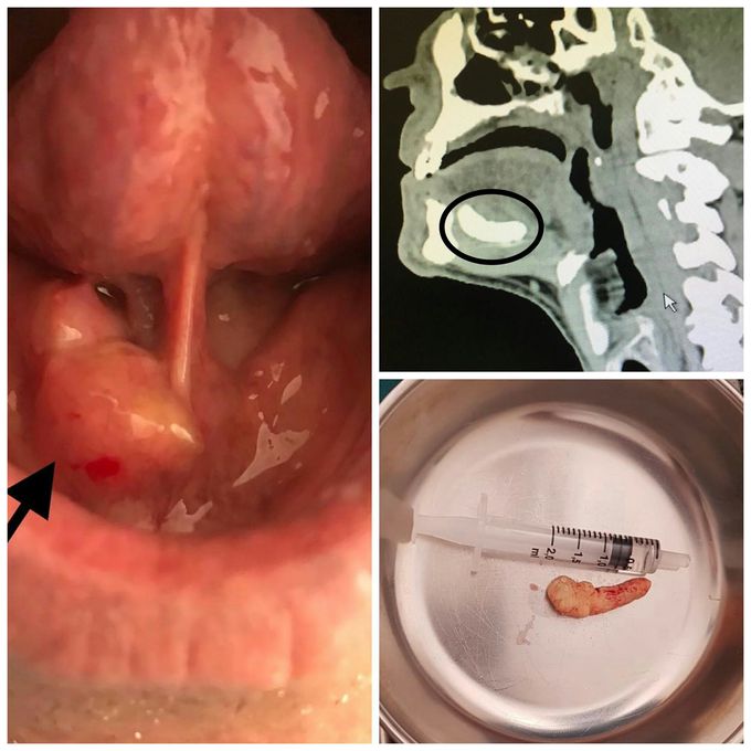Sialolithiasis