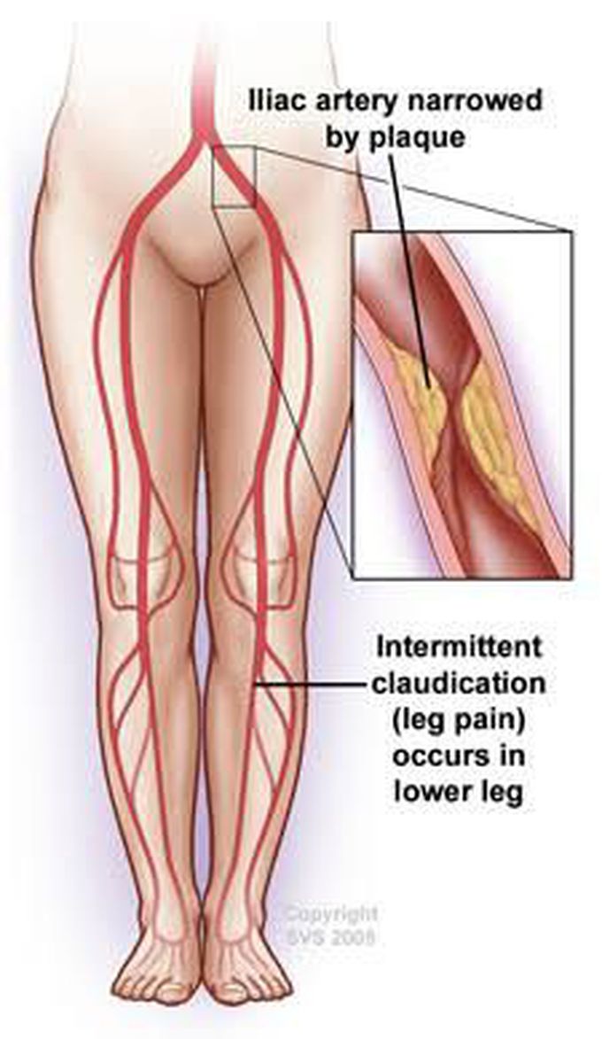 Causes of intermittent claudication