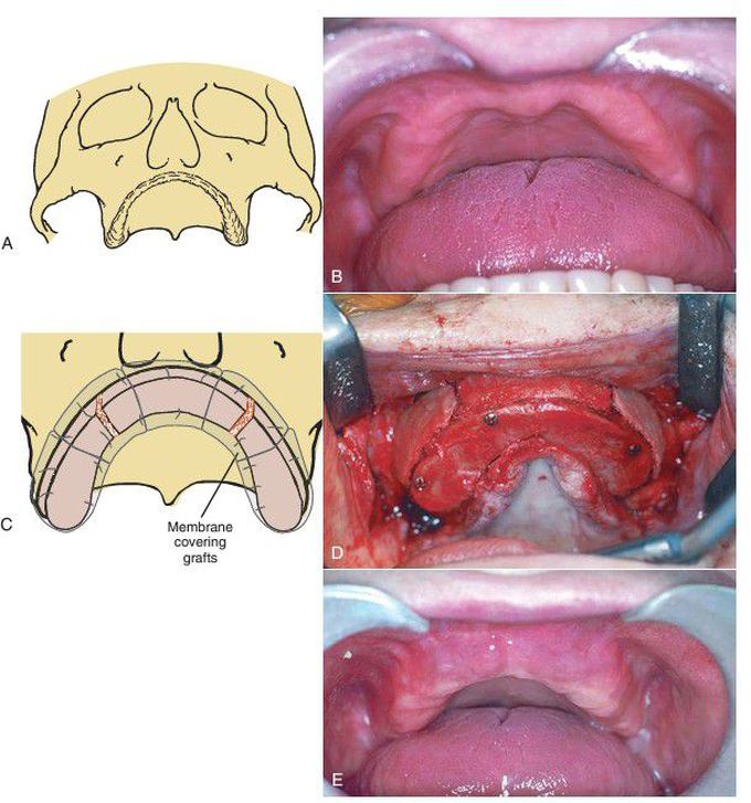 Iliac crest onlay bone reconstruction of maxilla.