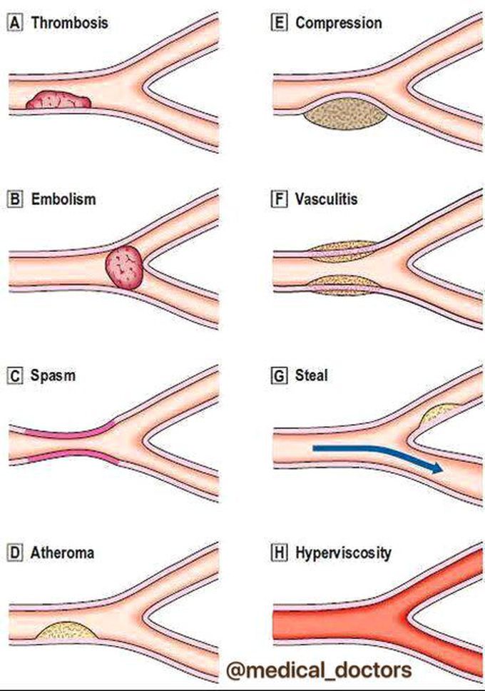 Pathological problem in blood vessels