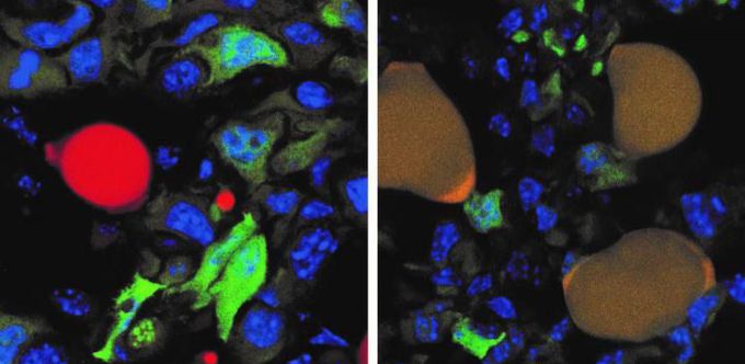 Scientists Successfully Turn Breast Cancer Cells Into Fat to Stop Them From Spreading
