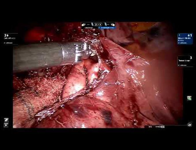 Robotic Lingulectomy With Bronchoplasty