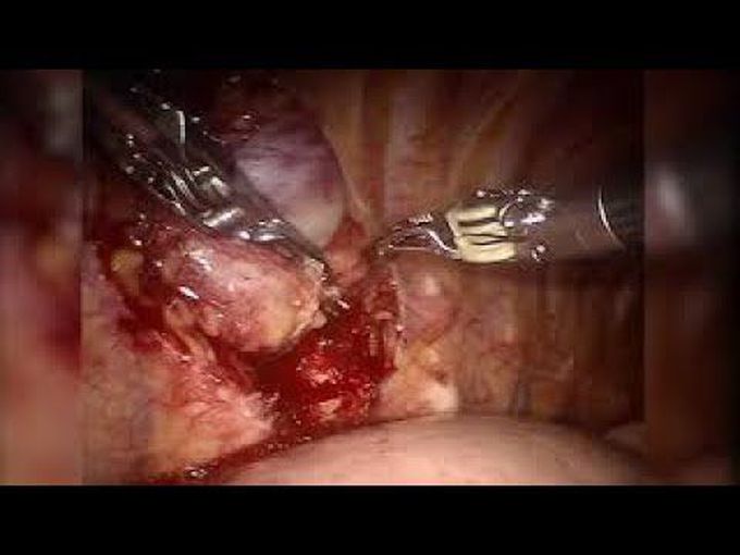 Robotic Excision of Posterior Mediastinal Schwannoma