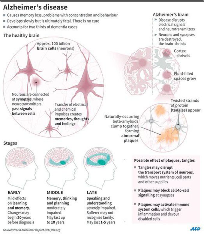 AI May Detect Alzheimer's Years Before Diagnosis