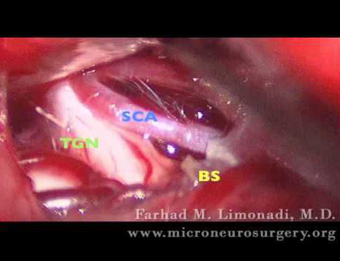 Trigeminal Neuralgia and Microvascular Decompression (brain surgery)