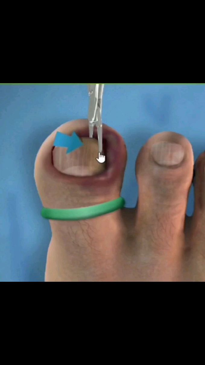 Ingrown toe nail removal surgery
