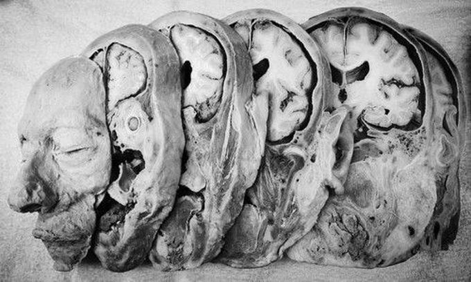 Coronal slices of a head