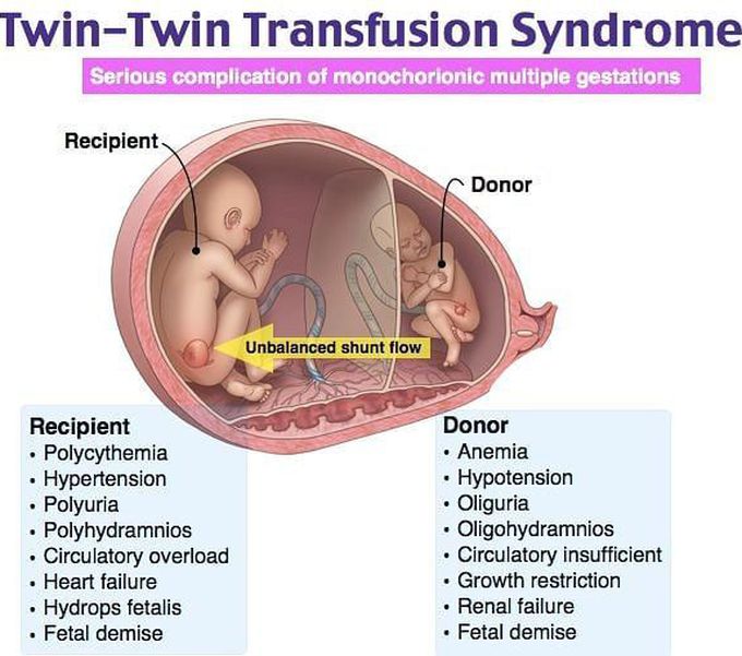 Twin twin transfusion syndrome