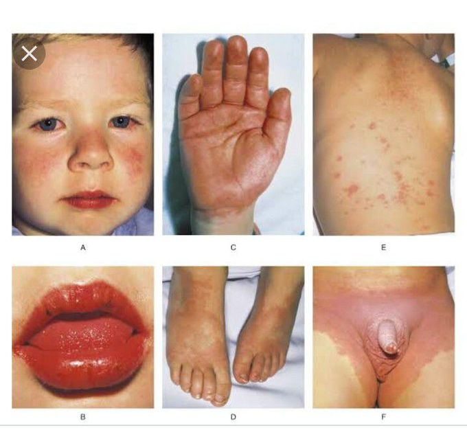 Kawasaki Disease