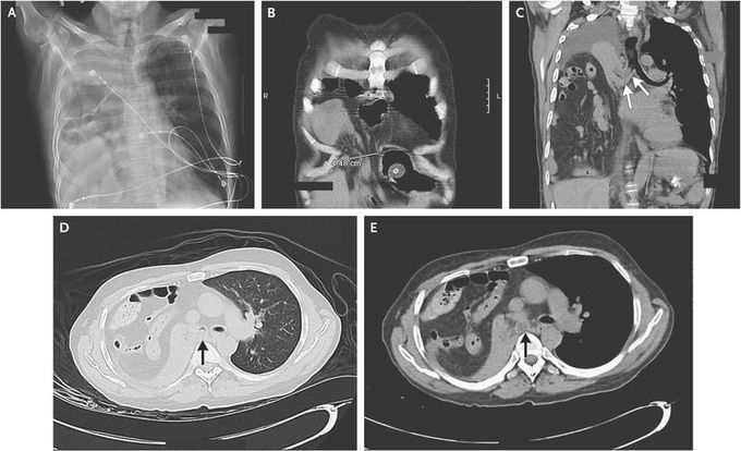 Diaphragmatic Hernia Causing Lung Collapse