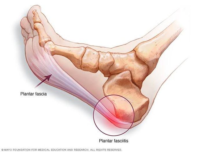 Cause of plamtar fasciitis