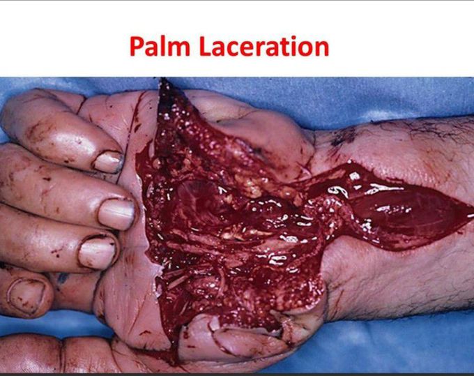 palm laceration