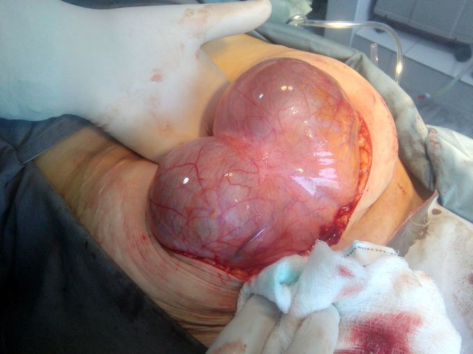 A huge right  site ovarian cyst.