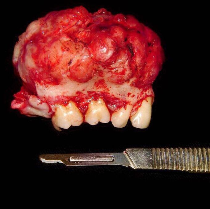 Resection of an  odontogenic tumor of maxilla MIXOMA🔪💀
