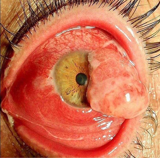 Conjuctival Squamous Cell Carcinoma...