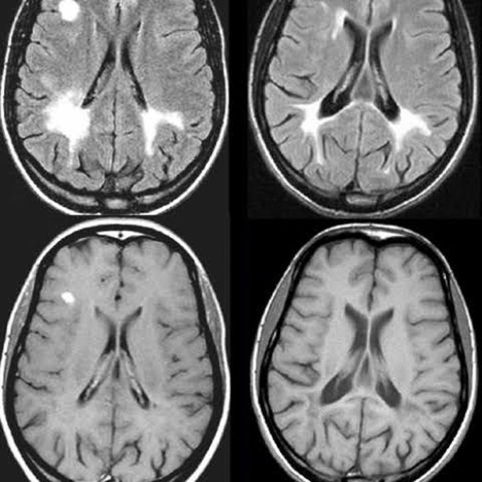 Causes of schilder's sclerosis