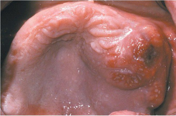 Carcinoma of the Maxillary Sinus.