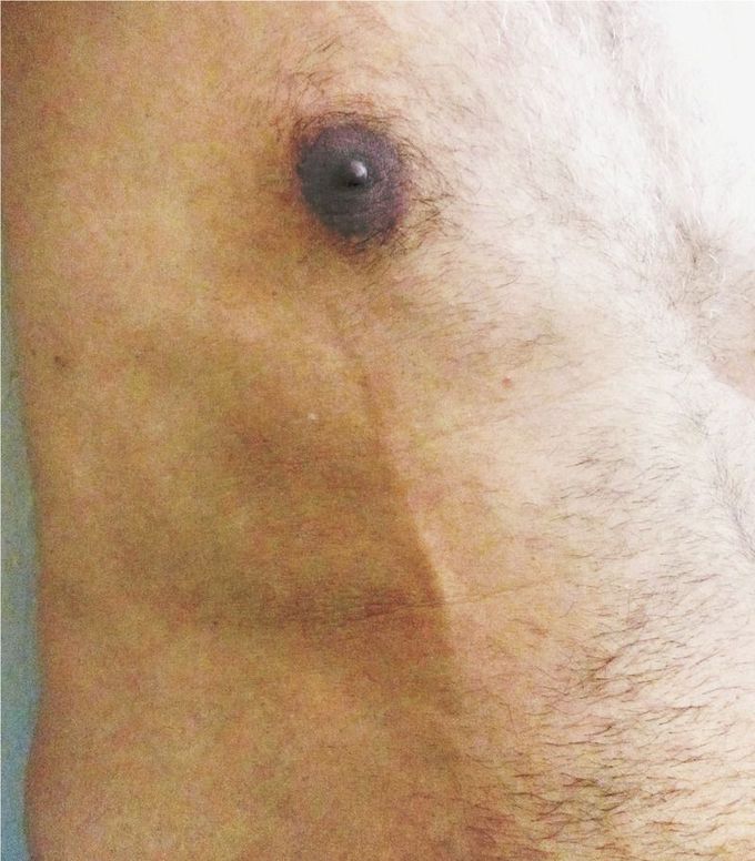 Mondor’s Disease