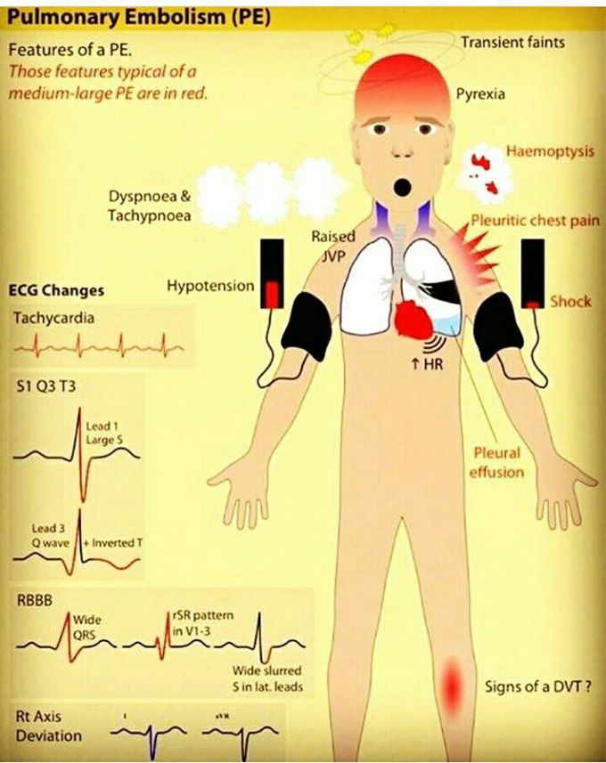 Pulmonary embolism...