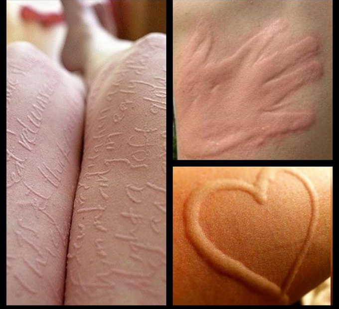 Dermatographia