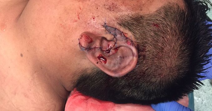 Reconstruction of the ear 👂