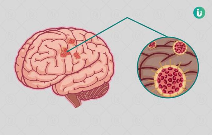 Signs and symptoms of encephalitis