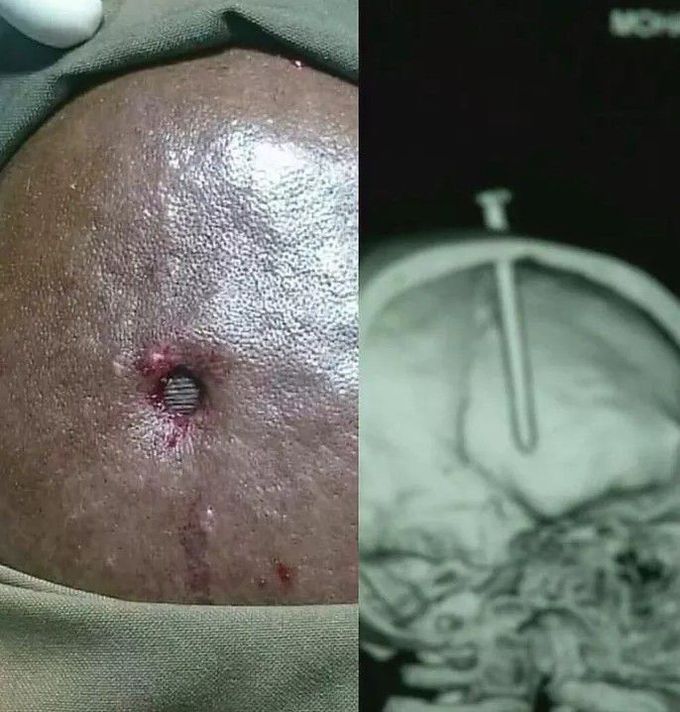 neurosurgery