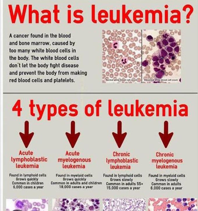 Types of leukemia