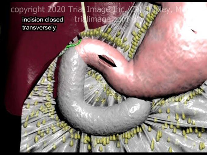 Heineke-Mikulicz Pyloroplasty (in 1 minute) Animation by Cal Shipley, M.D.