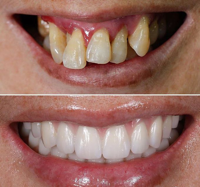 The effects of gum disease G. This patient came to clinic  with severe gum disease that affected all her teeth and made them so loose that she couldn't even eat or chew anything properly. She was diagnosed with severe generalized periodontitis. This disease significantly affects the bone and tissues that hold teeth together where bacteria causes an inflammation in the gums/bone and leads to a decrease in the supporting structures of the tooth and inevitably the teeth then have to be removed. Treatment involved extraction of all the teeth and placement of 6 implants where implant supported dentures were placed in both jaws. The bottom image is after a 1 year recall and the implant dentures look as good as new and still functional.😷🙏